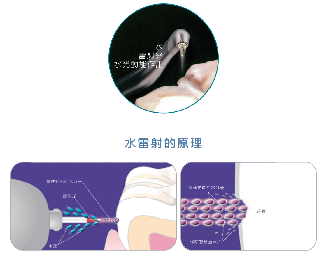 水雷射牙周治療原理示意圖｜尊兆牙醫診所