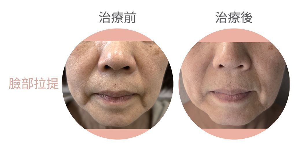 圖為薇拉電波效果示意圖