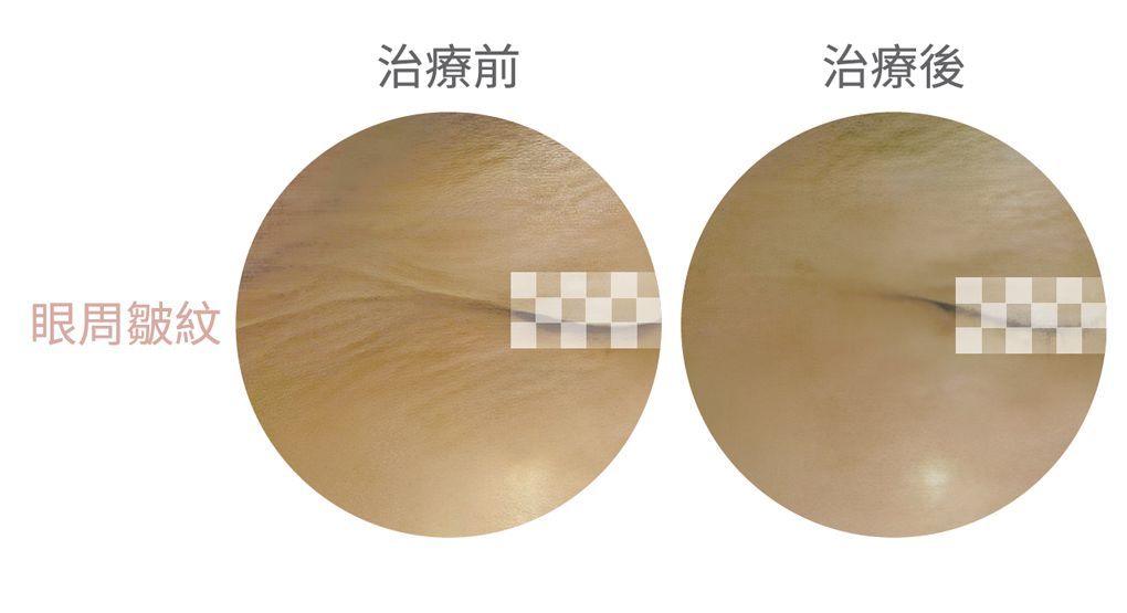 圖為薇拉電波效果示意圖