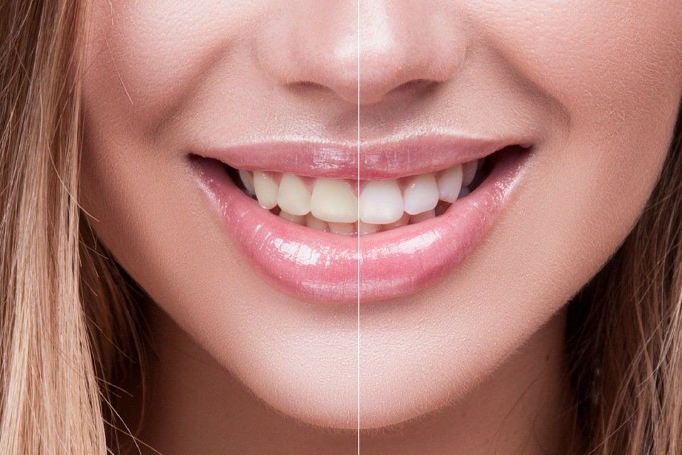 Before and after view of teeth whitening