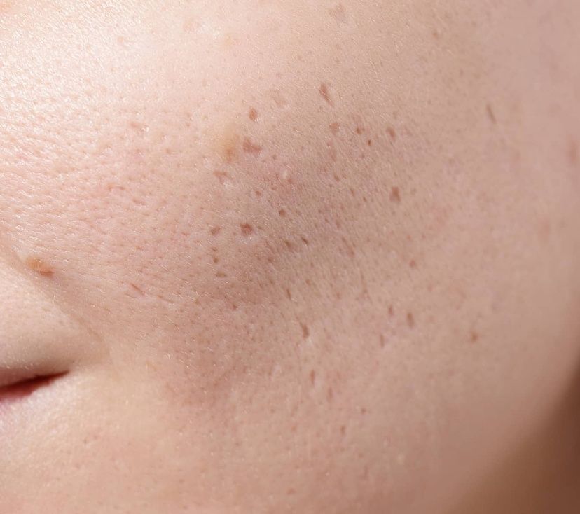 Een close-up van het gezicht van een vrouw met acne littekens.