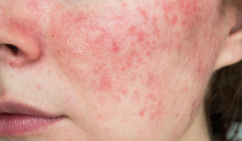 Close-up van iemands gezicht met rode, ontstoken huid, mogelijk rosacea, op de wangen.