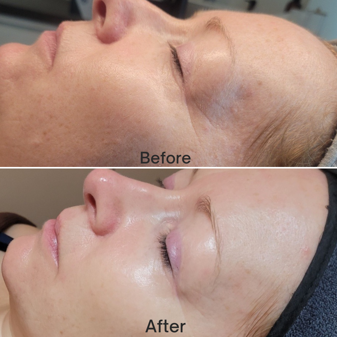 Een vergelijking van twee gezichten naast elkaar. De bovenste afbeelding toont de huid vóór de behandeling, met een doffe teint. De onderste afbeelding toont de huid ná de behandeling, met een stralendere huid.