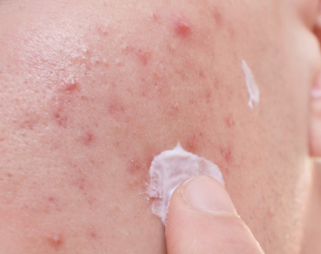 Een persoon met acne brengt crème aan op zijn gezicht.