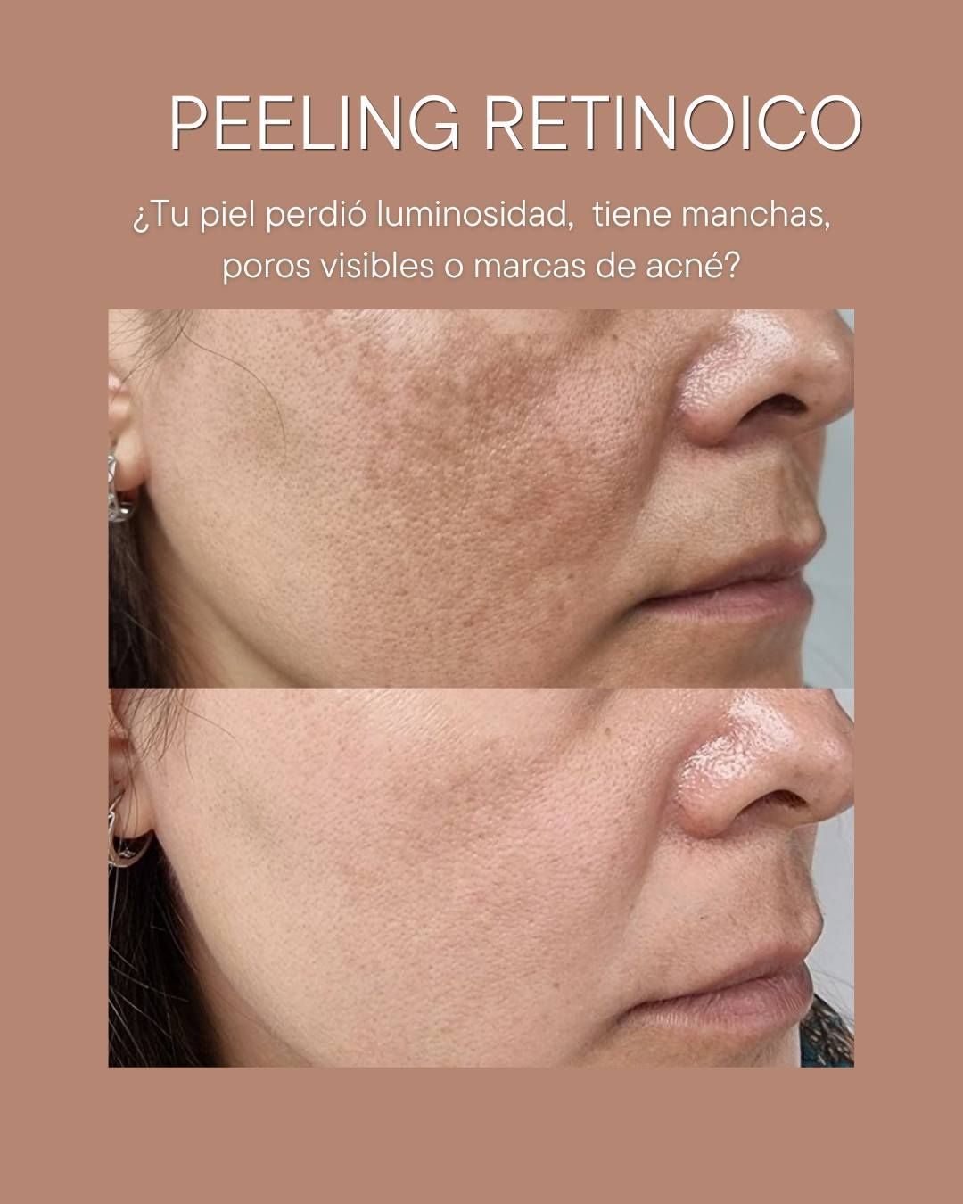 Primer plano de la piel del rostro antes y después del peeling con ácido retinoico, que muestra una reducción de las manchas oscuras.