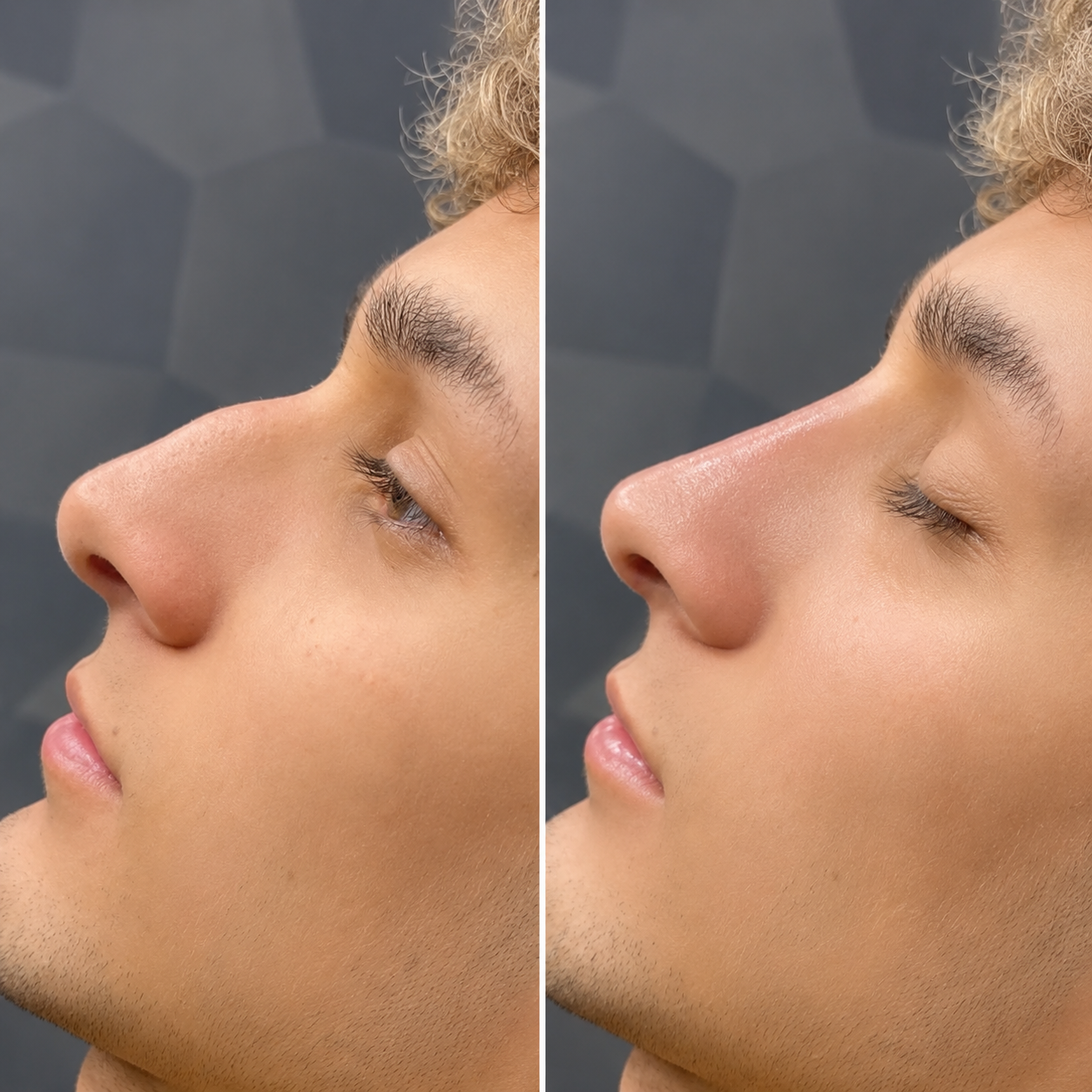 Sculptra es un bioestimulador de colágeno inyectable, diseñado para combatir la flacidez y mejorar la calidad de la piel. A diferencia de los rellenos dérmicos tradicionales, este tratamiento estimula la producción natural de colágeno del cuerpo, restaurando la firmeza, volumen y suavizando arrugas profundas