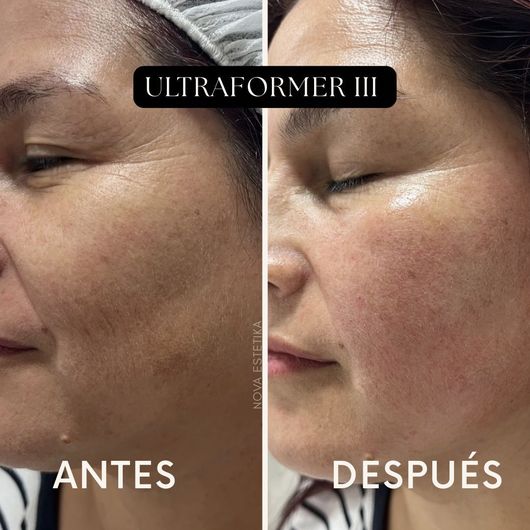 Primer plano comparativo de la piel del rostro, etiquetado como