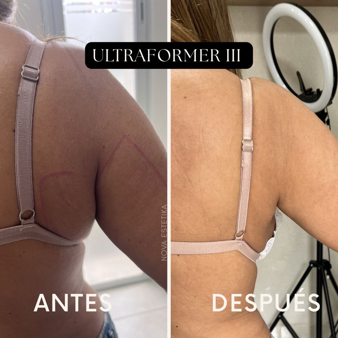 Antes y después de espalda/lateral con traje beige; texto “ULTRAFORMER III”, “ANTES” y “DESPUÉS”.