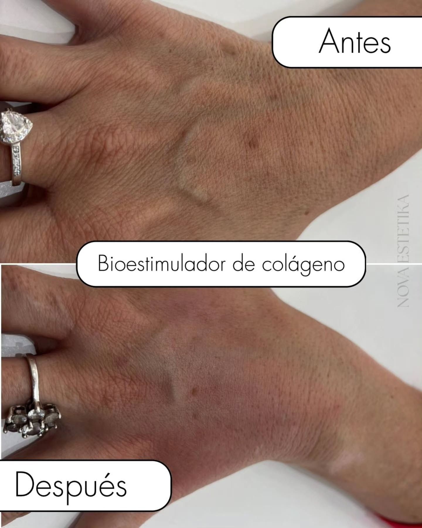 Comparación del antes y el después de una mano tratada con un bioestimulador de colágeno