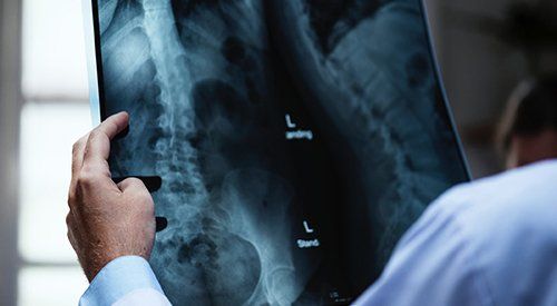 A doctor is looking at an x-ray of a person 's spine.