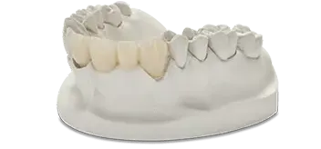 Crowns-and-Bridges-teeth