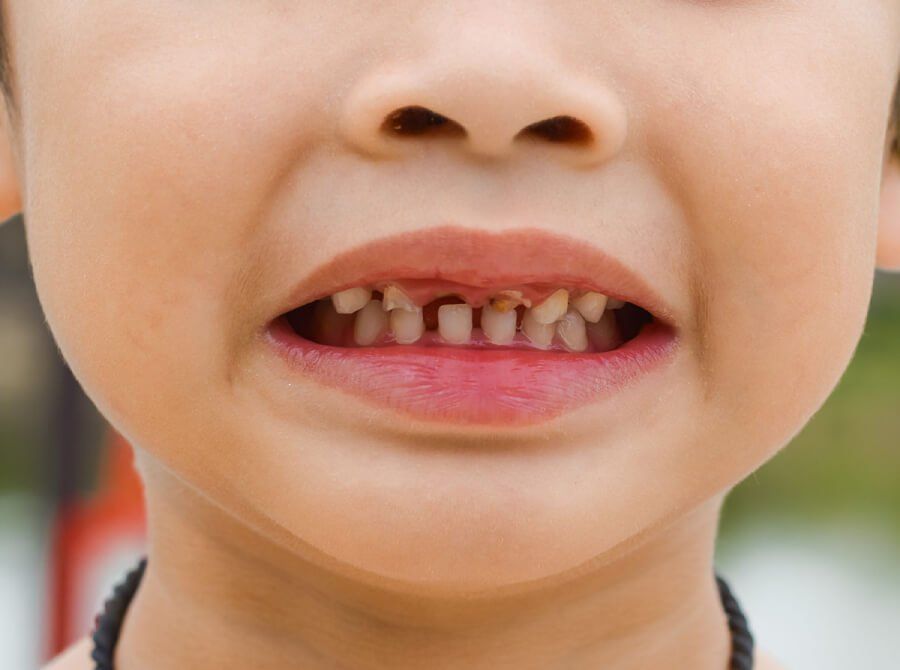 Детский кариес – самое распространенное стоматологическое заболевание среди детей