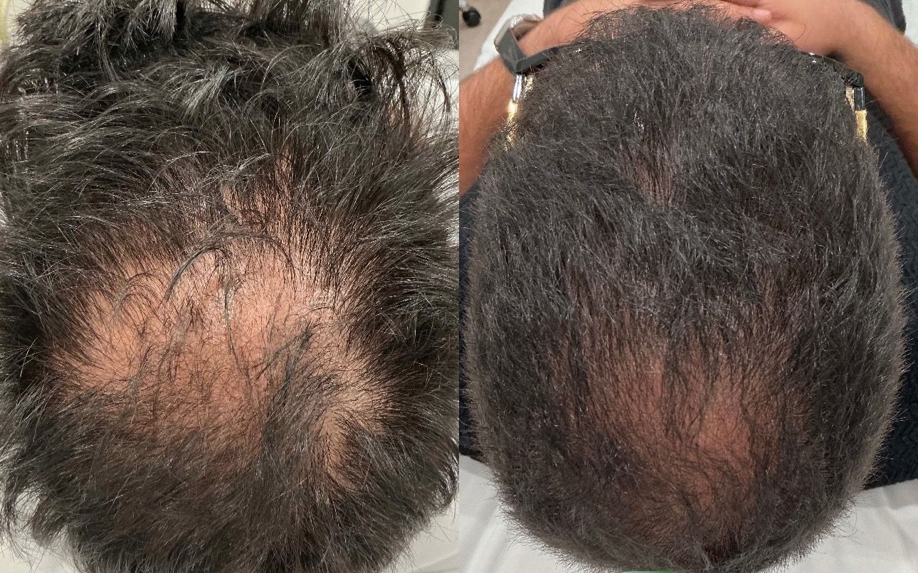 Comparison of two views of a person's head, showing hair growth progress.