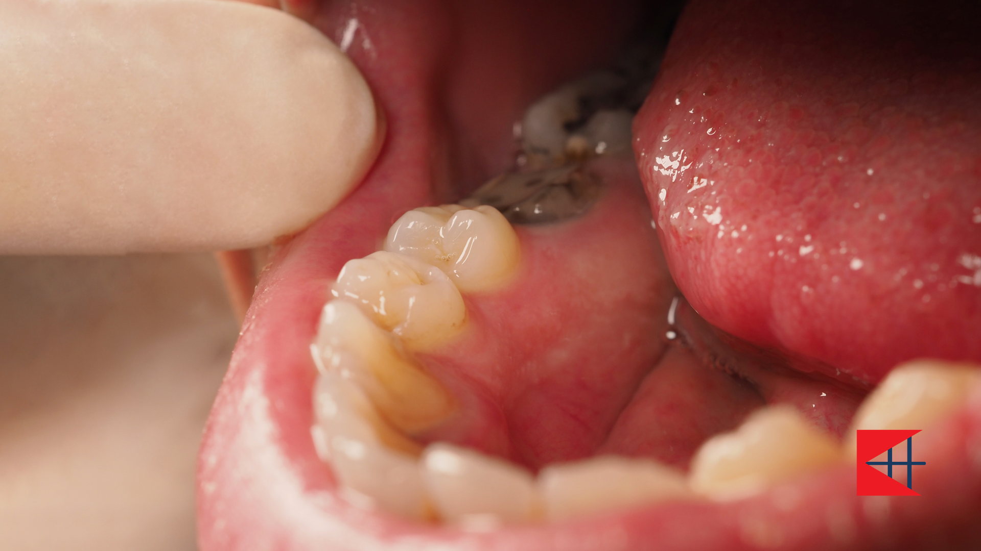 A close up of a person 's mouth with a tooth missing.