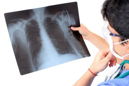 dottore scruta radiografia polmonare