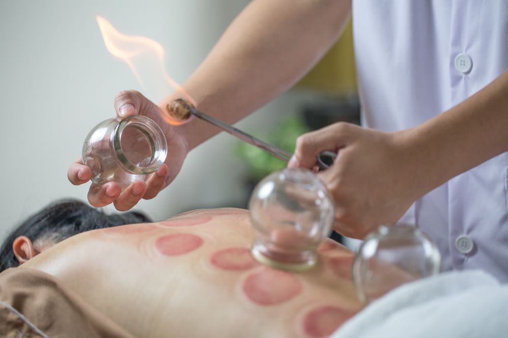 Person Performing Cupping Therapy on a Patient's Back Using Flame — A1 Coffs Harbour in Coffs Harbour, NSW