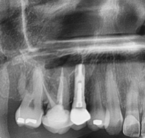 DR. ASDRUBAL RODRIGUEZ ROJAS-implantes dentales