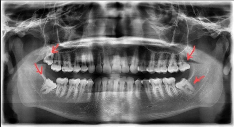 DR. ASDRUBAL RODRIGUEZ ROJAS-terceros molares