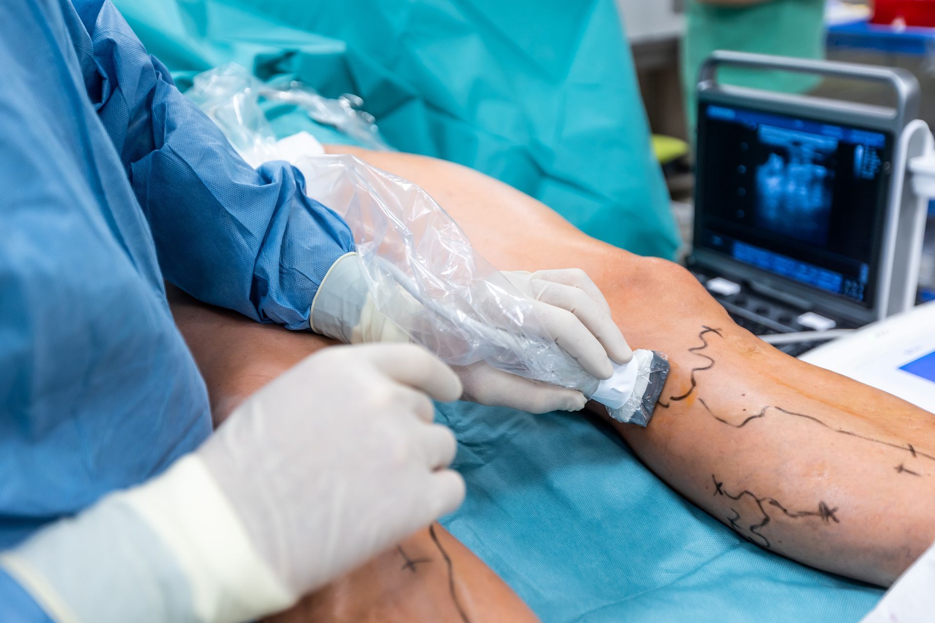 Process of varicose vein surgery in hospital.