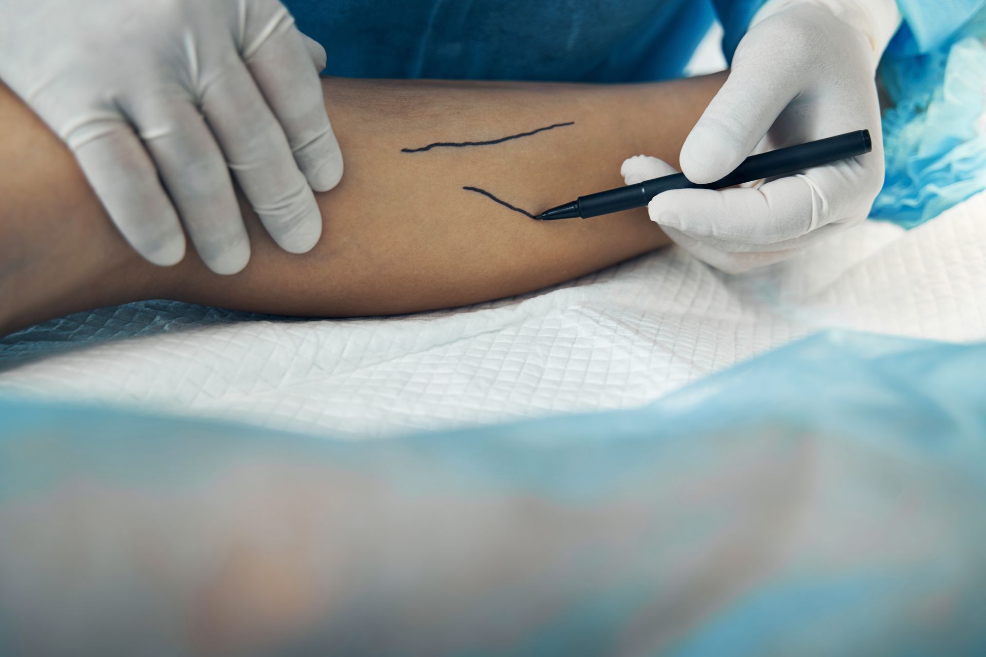 Gloved hands mark lines on a patient’s leg in preparation for a medical procedure.] 