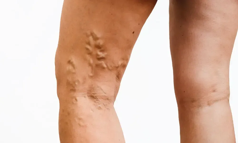A woman 's legs with varicose veins on a white background.