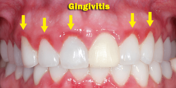 Gingivitis