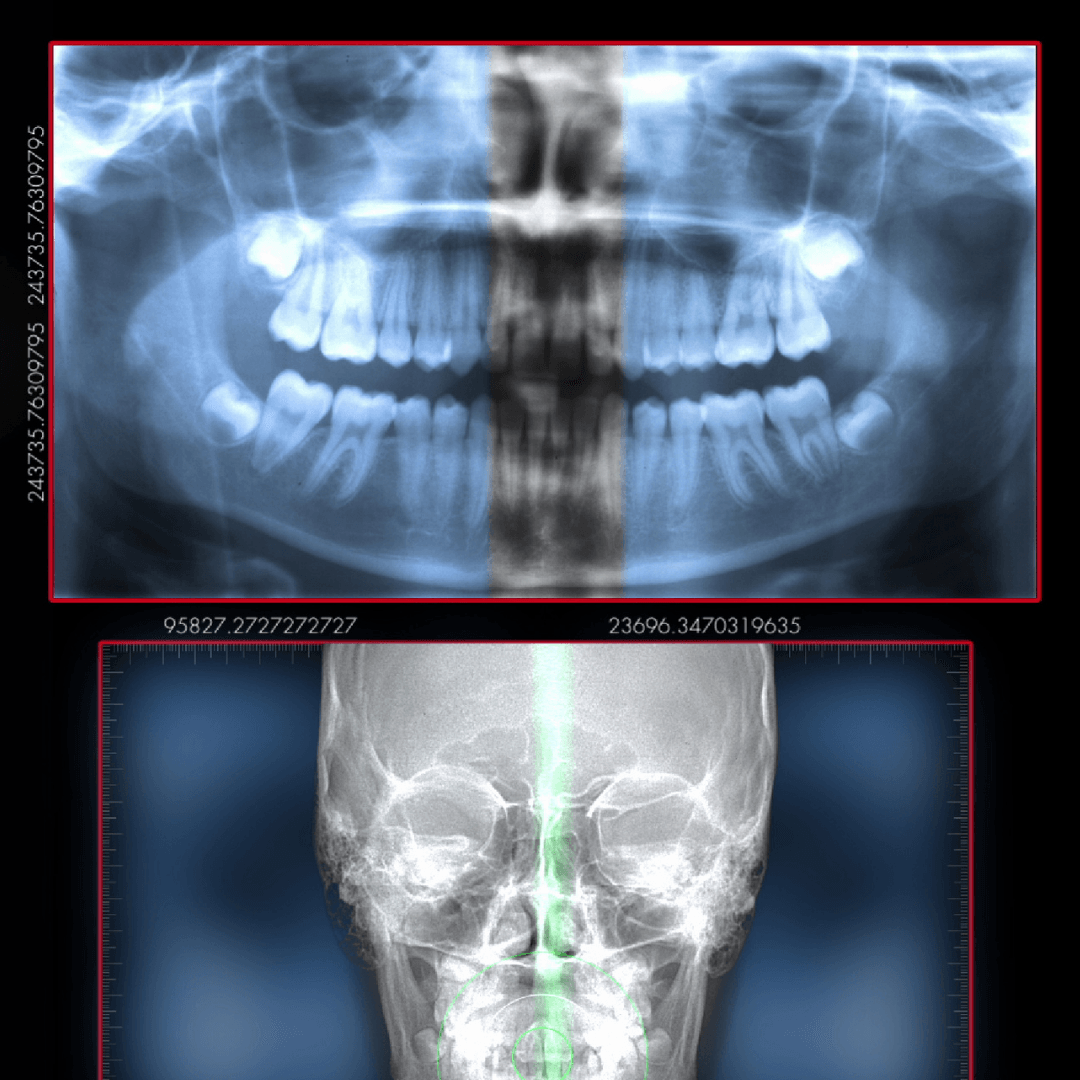 Mouth and skull xray | Modern technology | Adult and Pediatric Dentist Mt. Pleasant SC