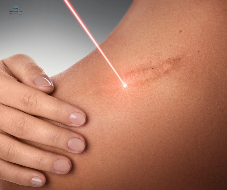 Medical laser being used to perform skin resurfacing procedure