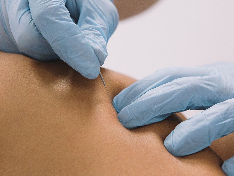 dry needling at Southwind Physical Therapy