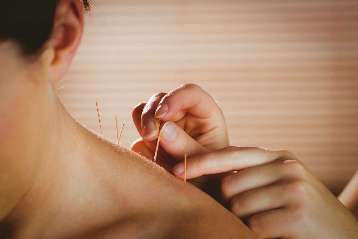 A person is getting acupuncture on their back.