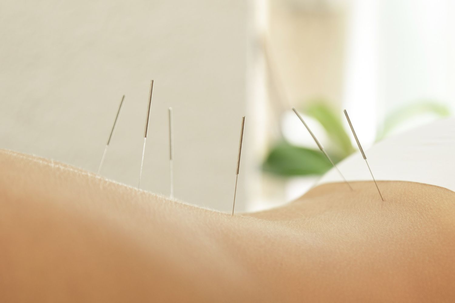 A close-up view of thin acupuncture needles inserted into a person's lower back.