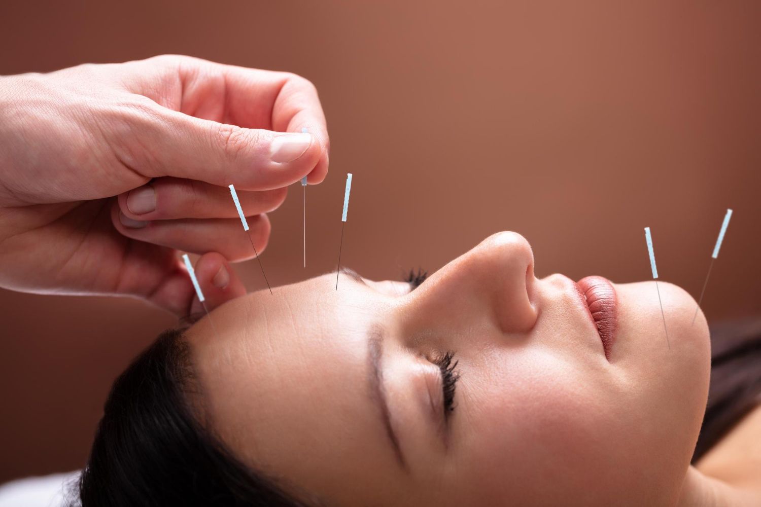A woman is getting acupuncture on her face.
