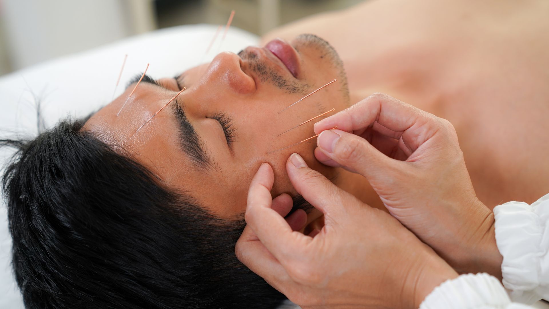Man receiving facial acupuncture treatment; needles inserted into his cheek, close-up.