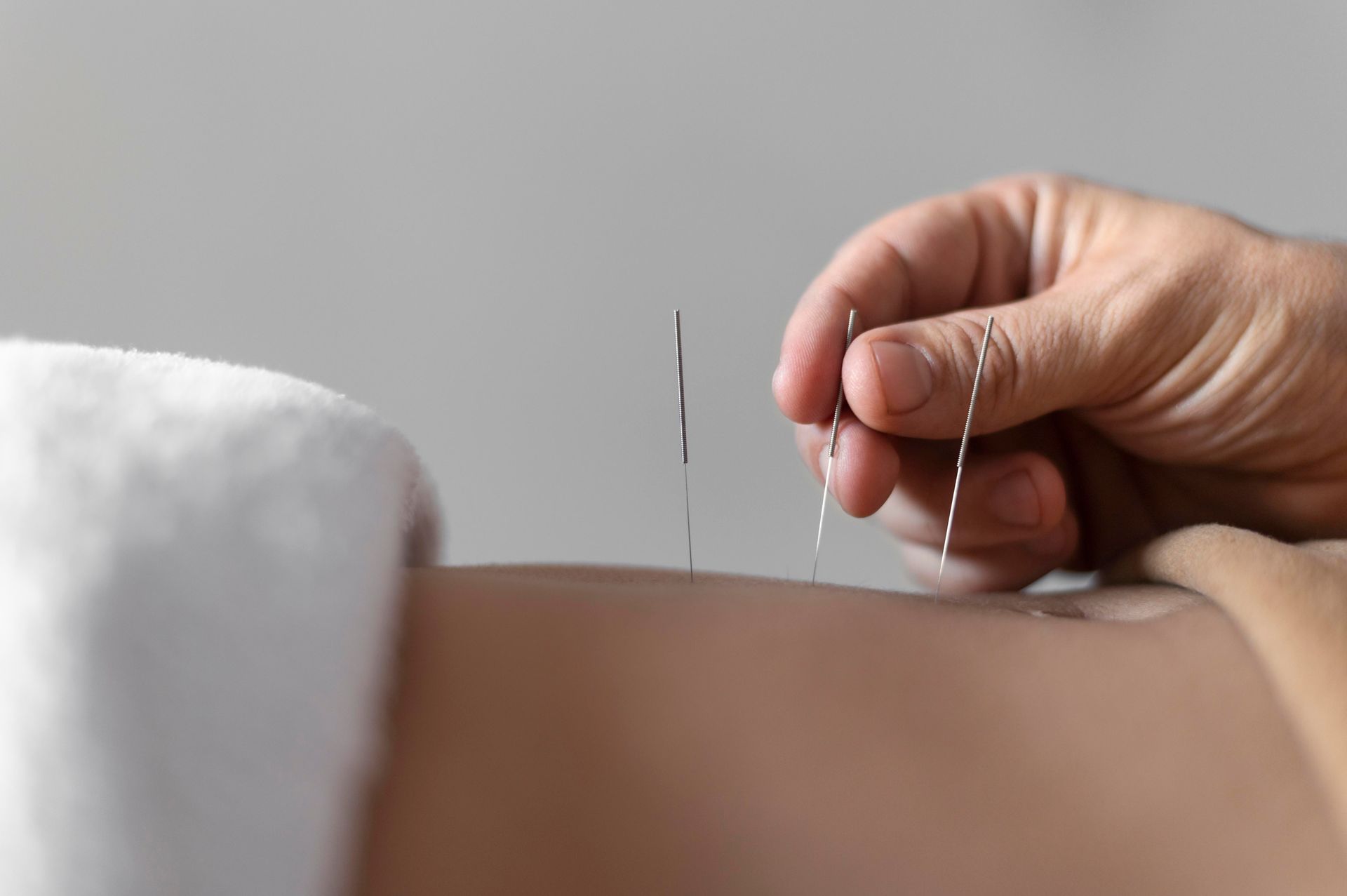 A person is getting acupuncture on their back.