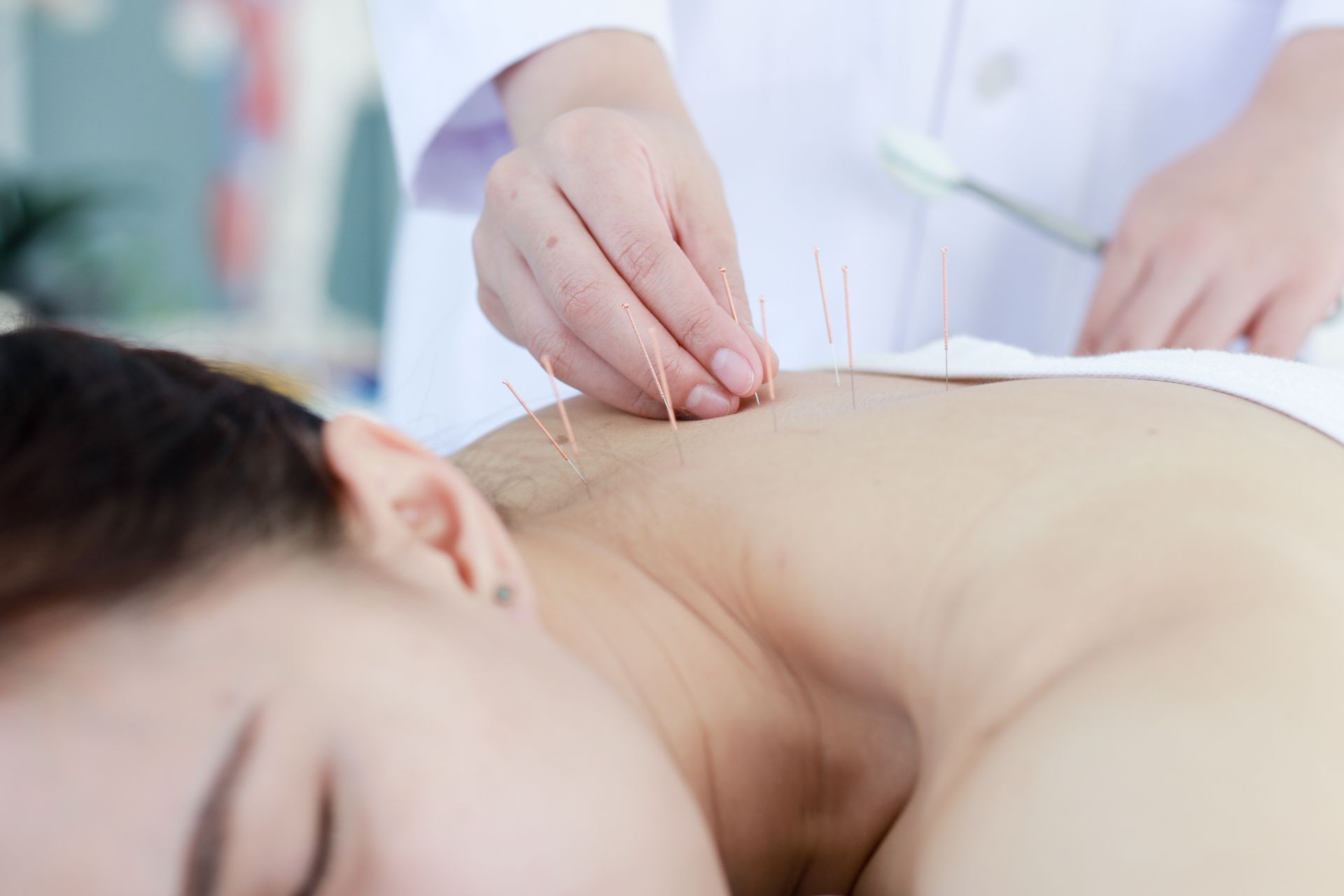 A woman is getting acupuncture on her back by a doctor.