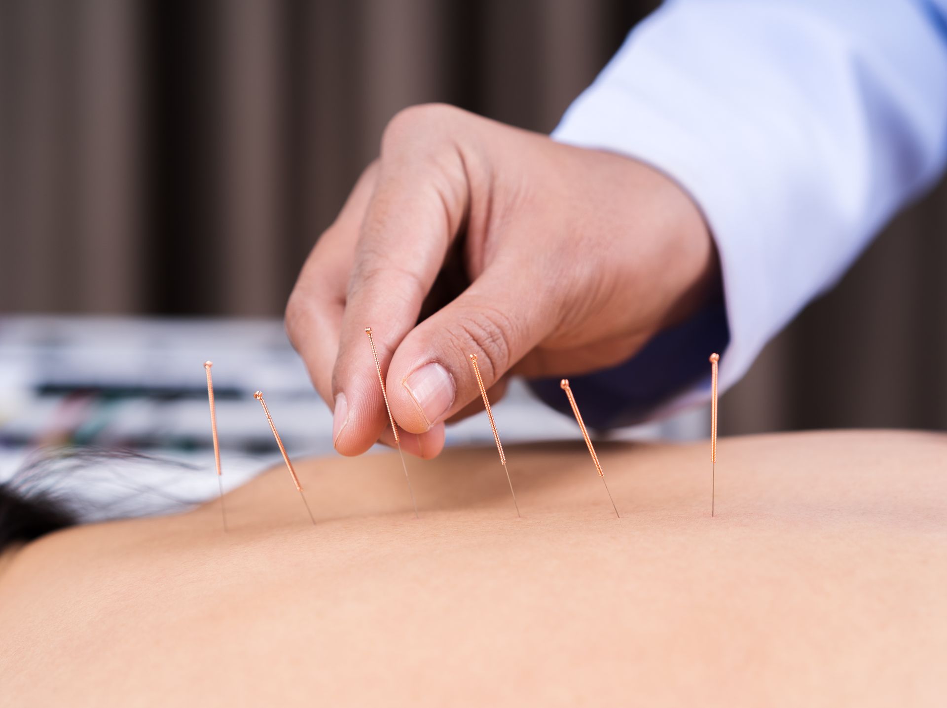 Hand placing acupuncture needles in a person's back.