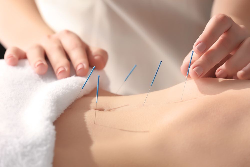 A person is getting acupuncture on their back.