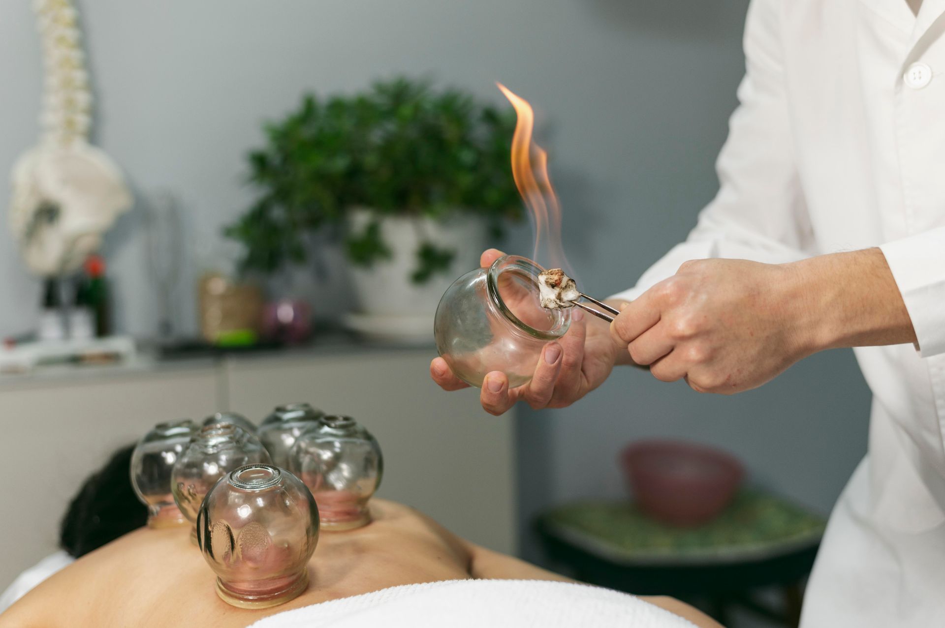 Therapist using a flame to heat a glass cup for cupping therapy on a person's back.