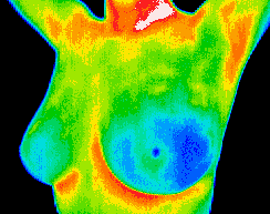 A thermal image scan of a female breast