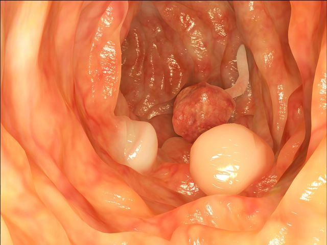 Colon Screening for Colorectal Cancer | Athens Gastroenterology Center