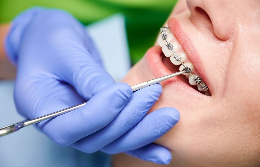 Dentist examining a person's teeth with braces, wearing blue gloves.