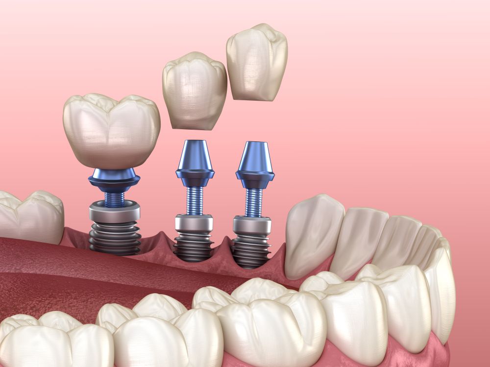 A 3d rendering of a dental implant in a person 's mouth.