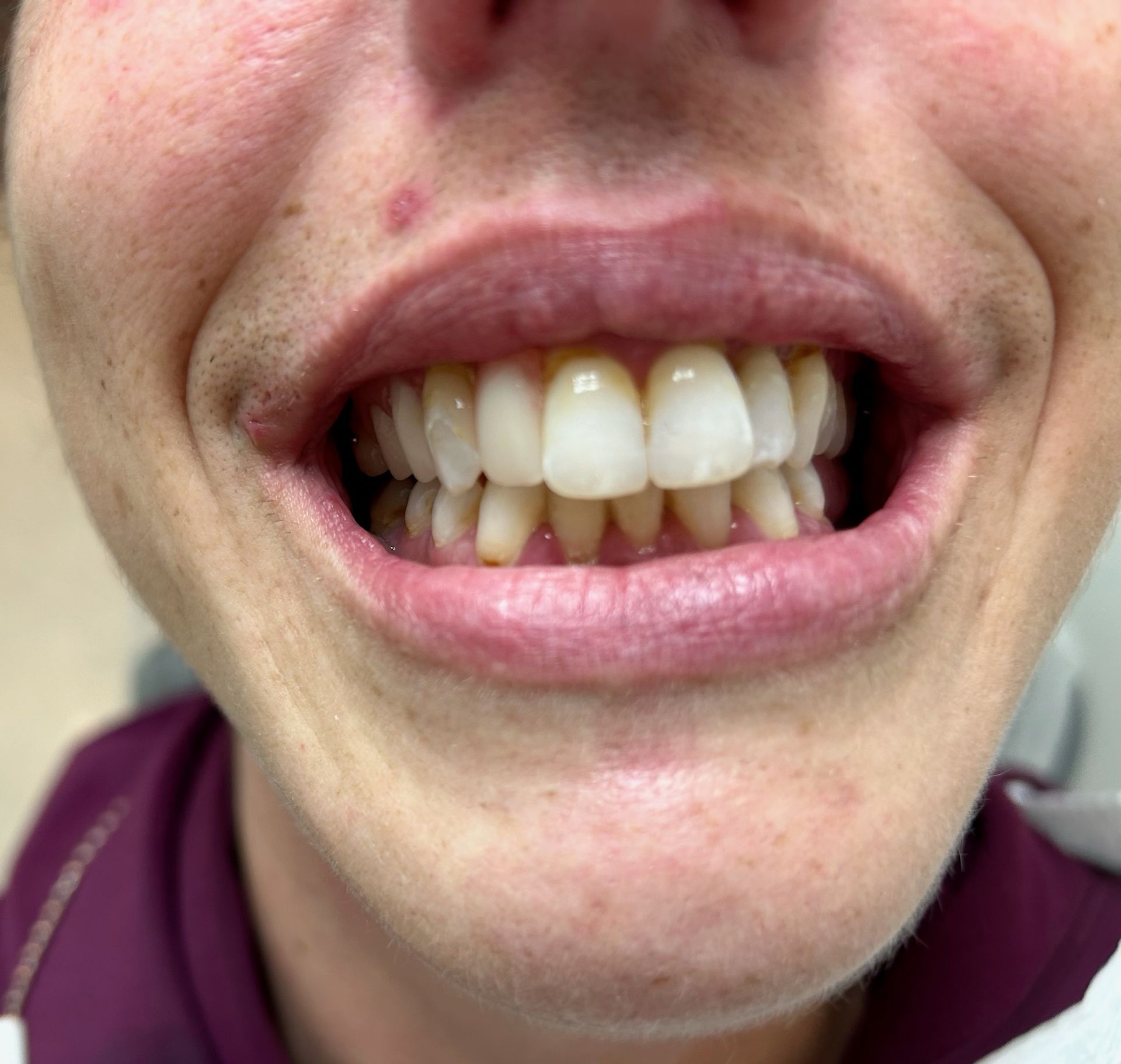 Close-up of a person smiling, showing teeth that are yellowed. The lips and skin have a pale tone.