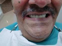 Close-up of a person smiling, showing new dentures. The person has a mustache and is wearing a bib.