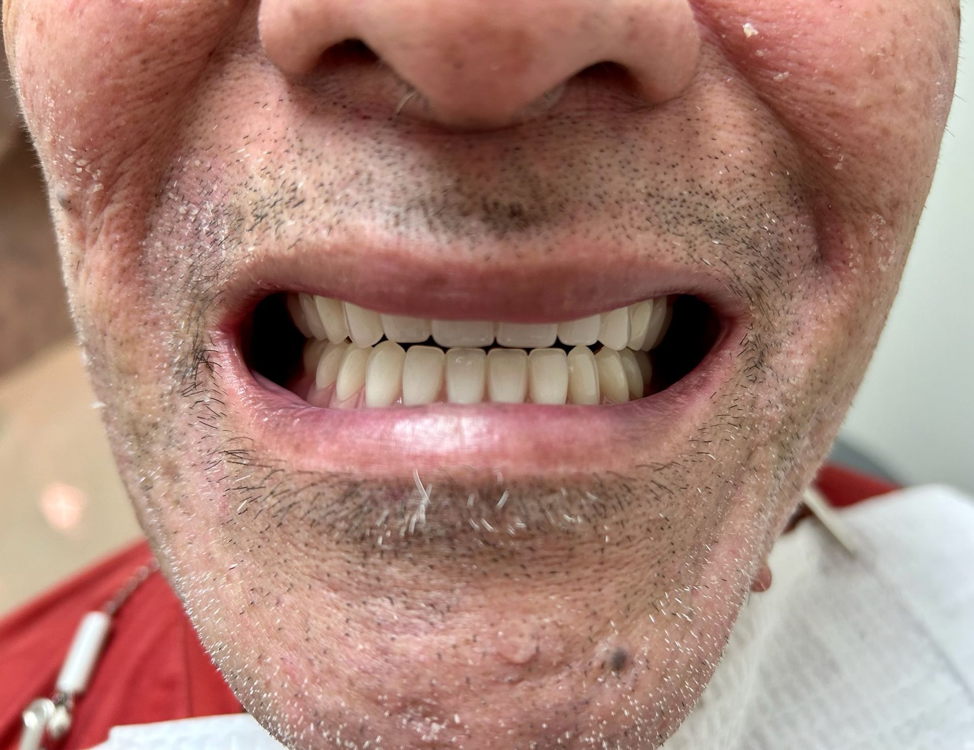 Close-up of a man's open mouth, showing a full set of white teeth. He has facial stubble, and a medical bib.