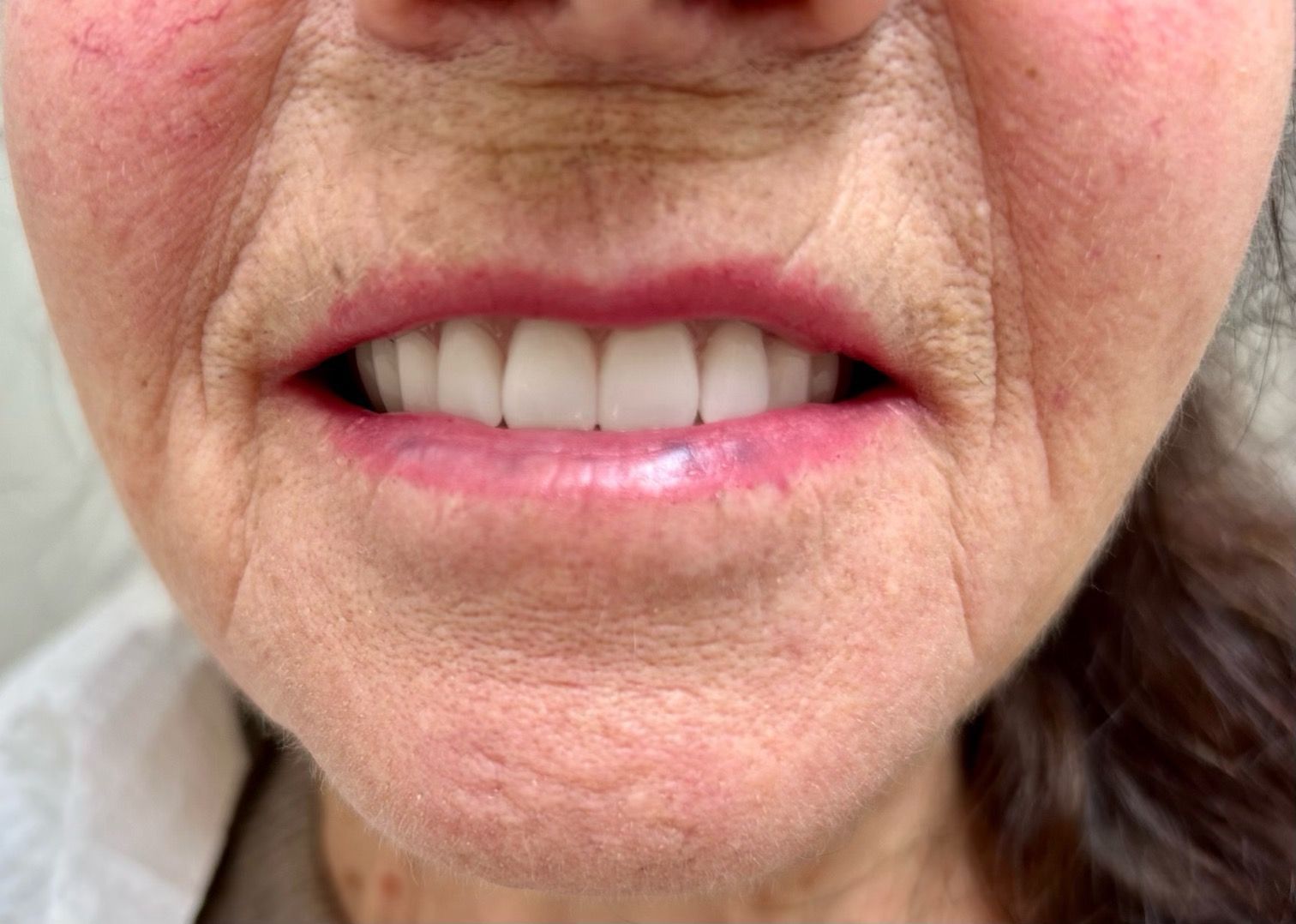 Close-up of a person's mouth with bright, white teeth and pink lipstick, surrounded by wrinkled skin.