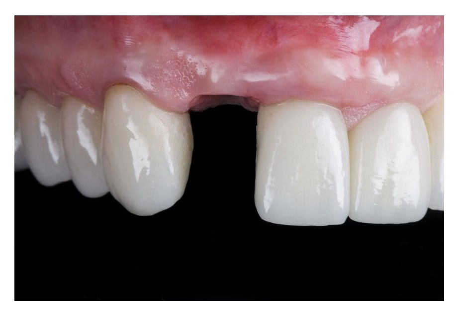 Side-by-side dental comparison: Before with missing tooth, after with full, white set of teeth.