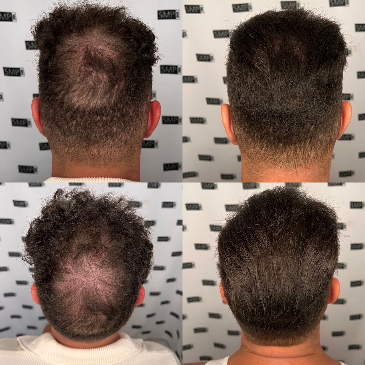 Four photos showing the back of a man's head. Hair loss progression and regrowth shown over time.