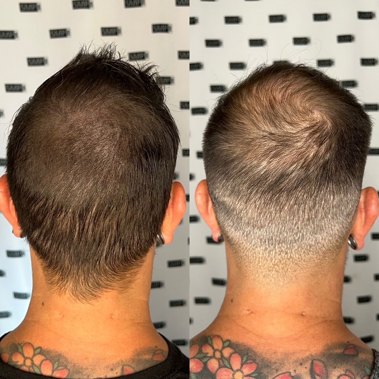 Before and after shots of the back of a head with thinning hair. The after is a faded, close haircut.