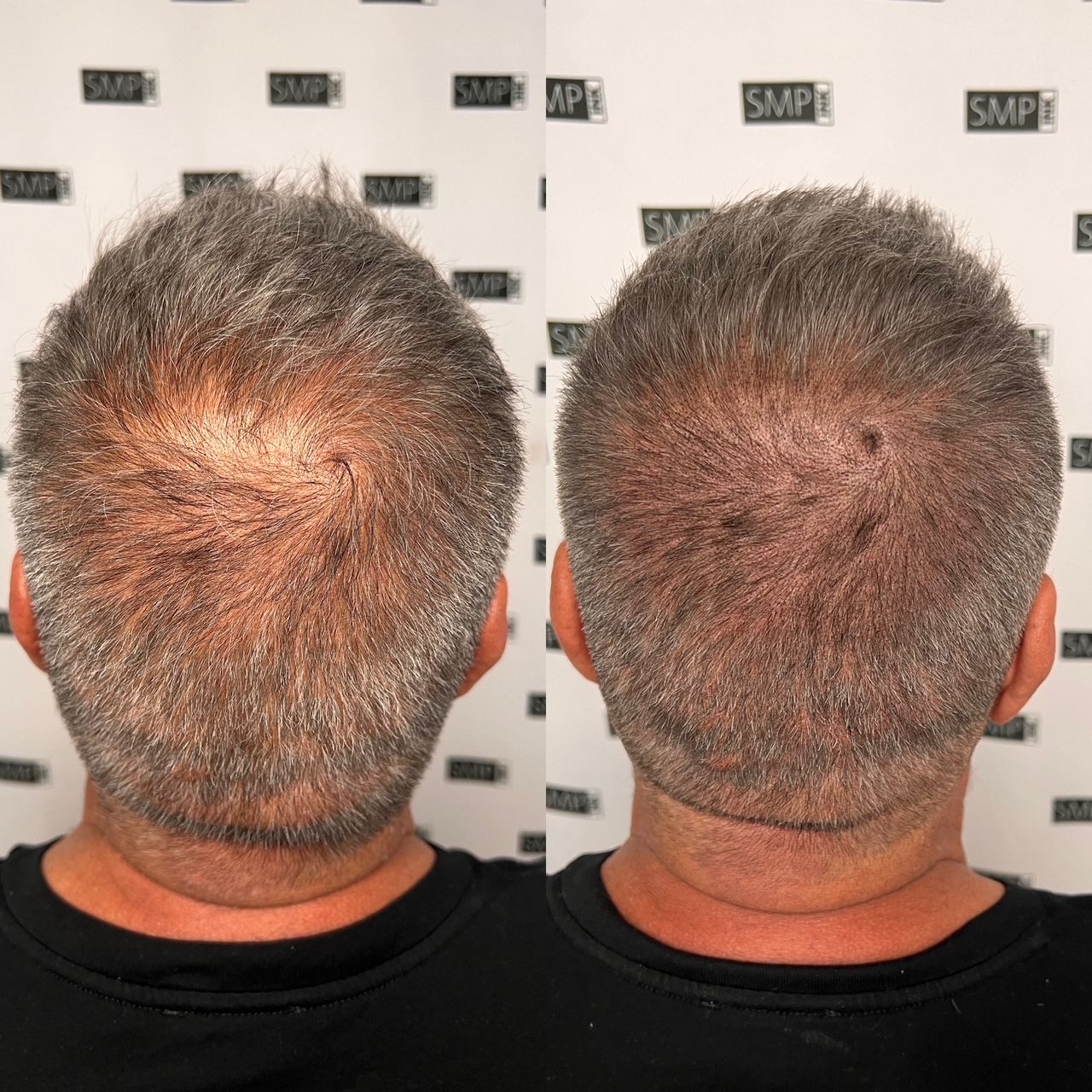 Before and after views of scalp micropigmentation on a man's head, showing filled-in hairline.